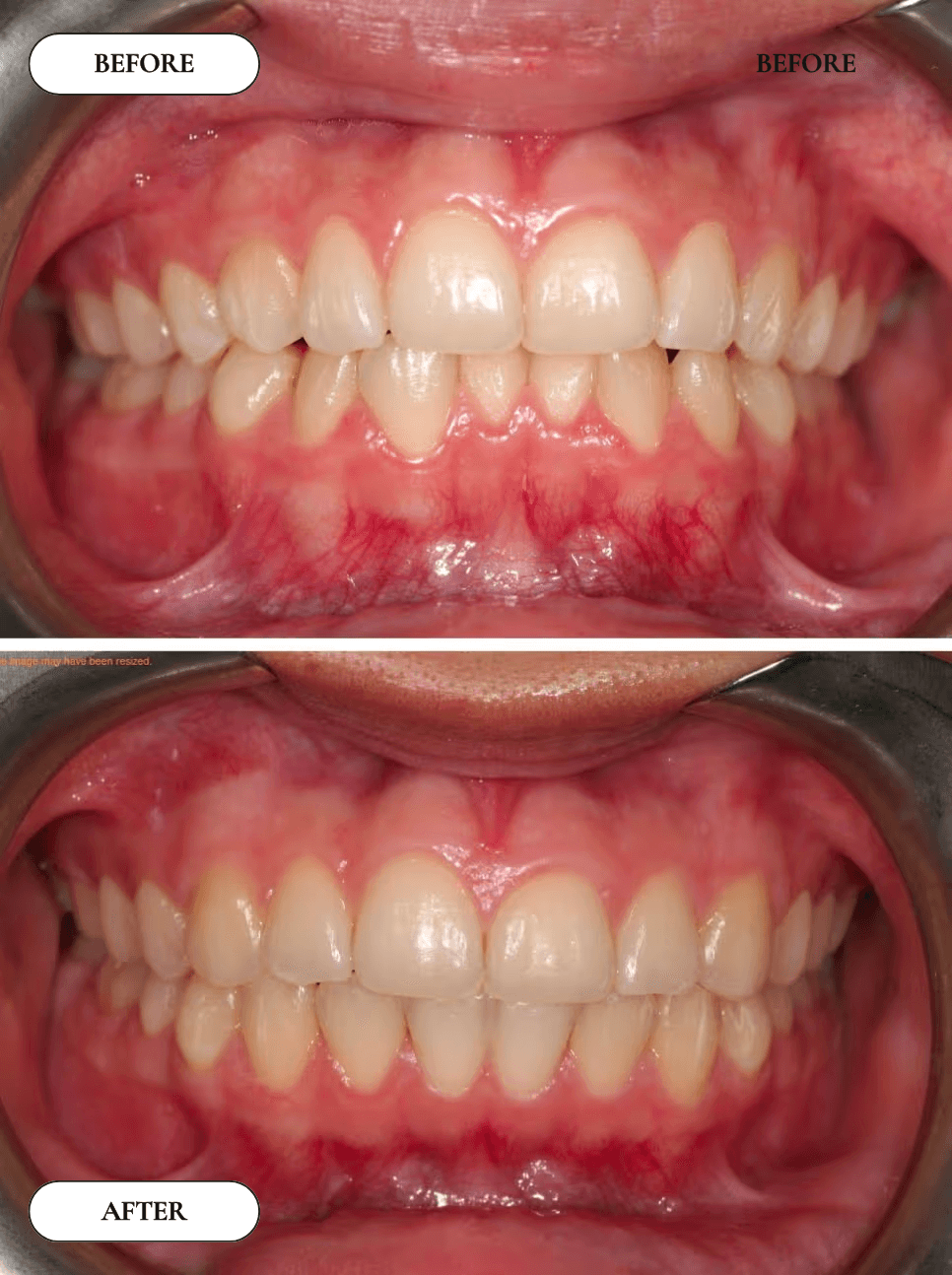 Smile Transformation 1 - Before and After