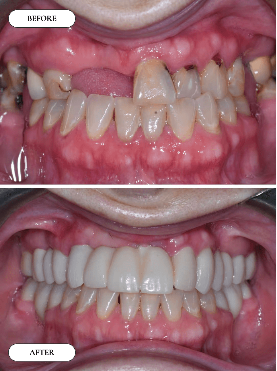 Smile Transformation 10 - Before and After