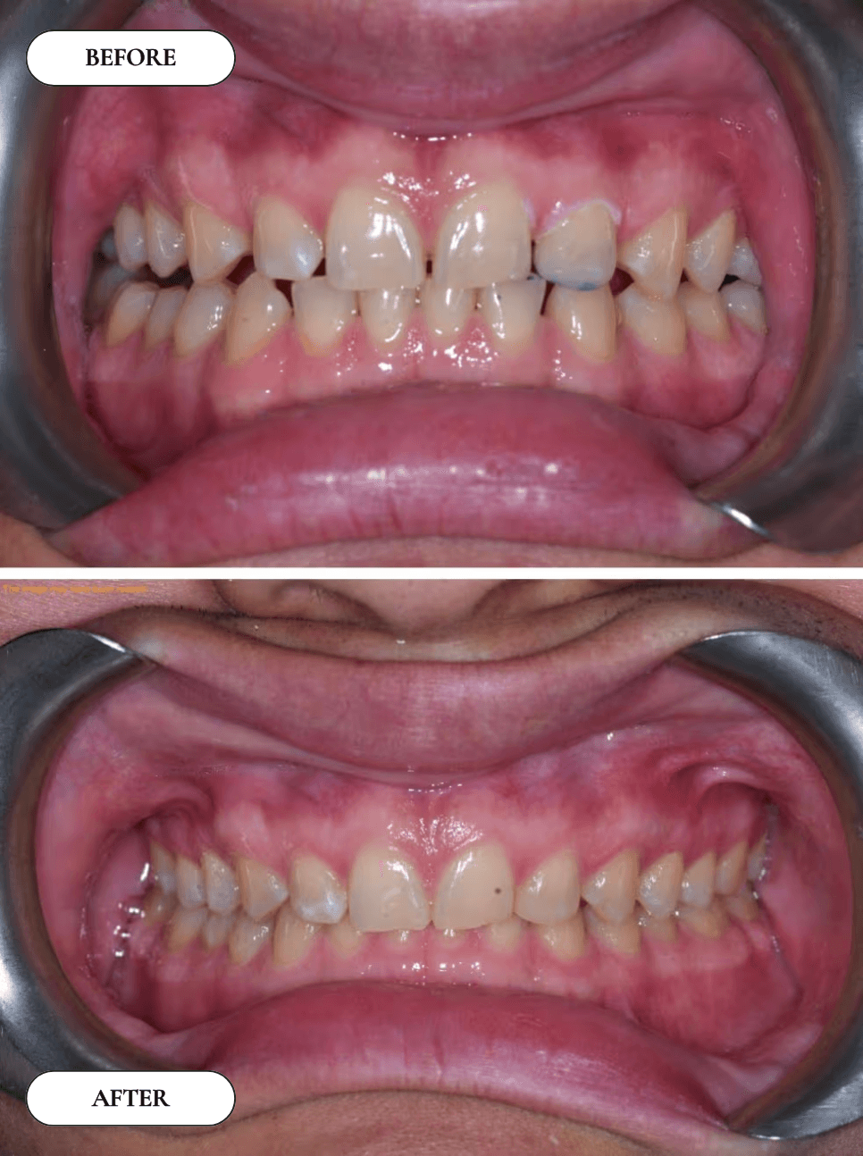 Smile Transformation 11 - Before and After
