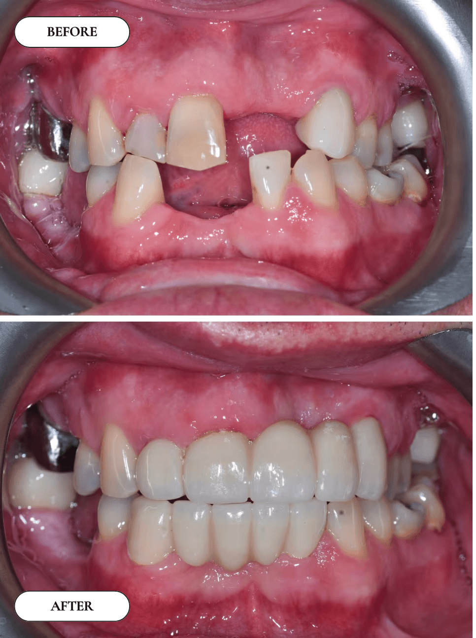 Smile Transformation 2 - Before and After