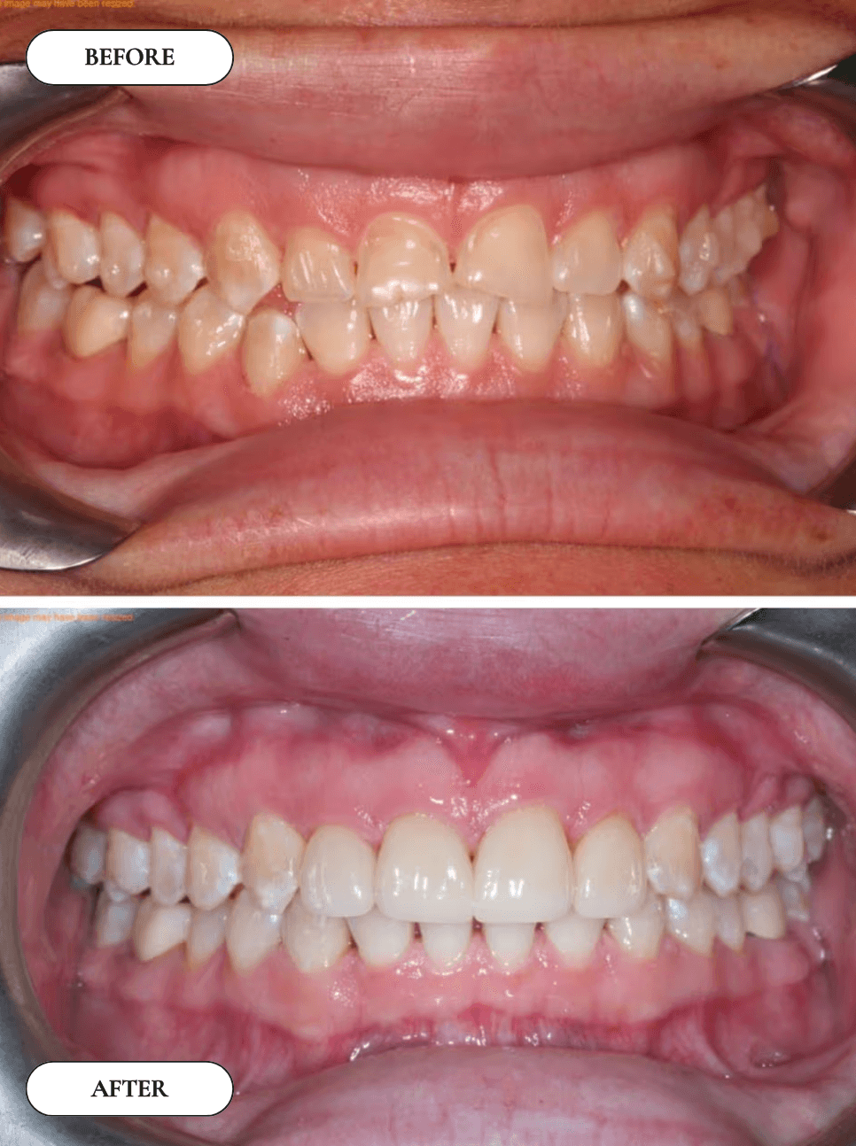 Smile Transformation 3 - Before and After