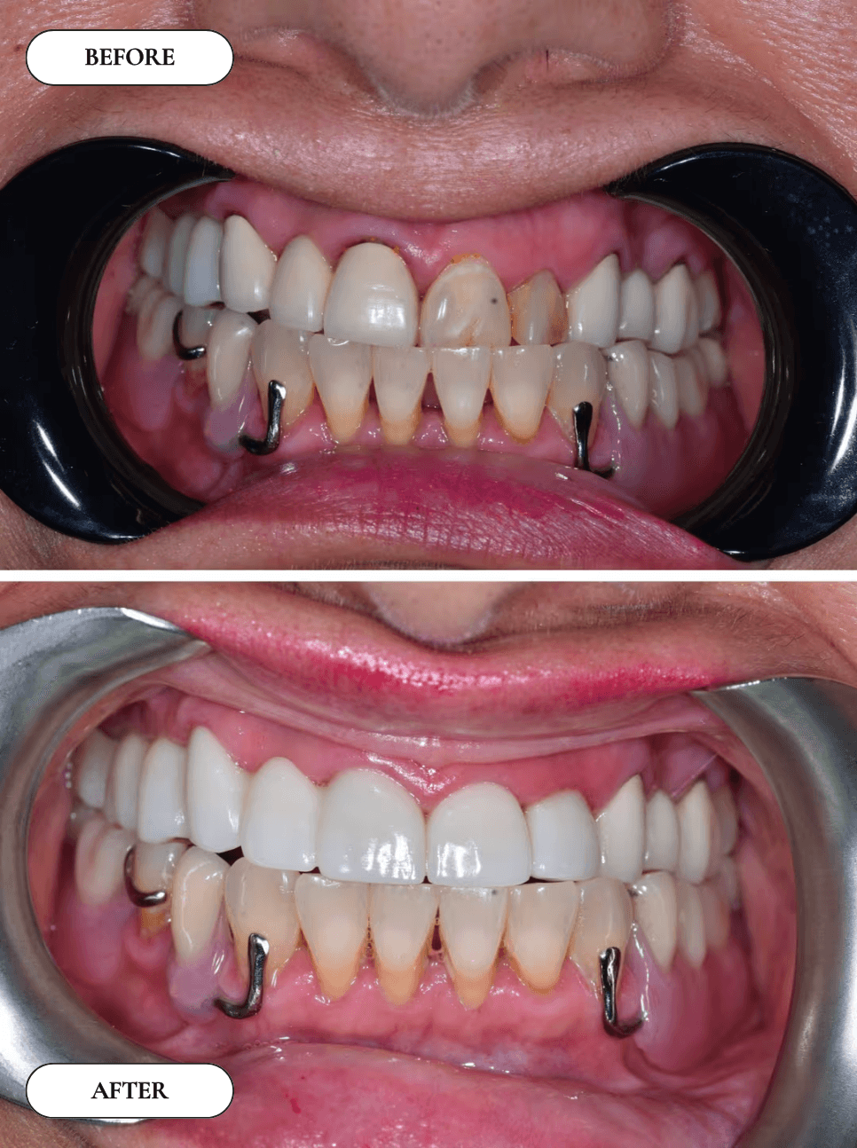 Smile Transformation 4 - Before and After