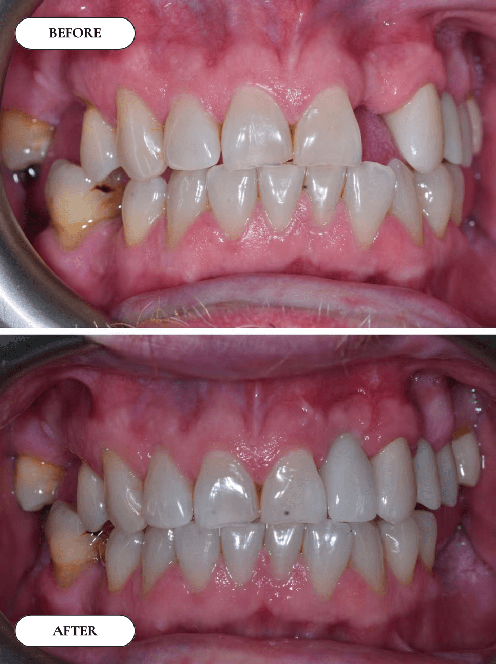 Smile Transformation 5 - Before and After