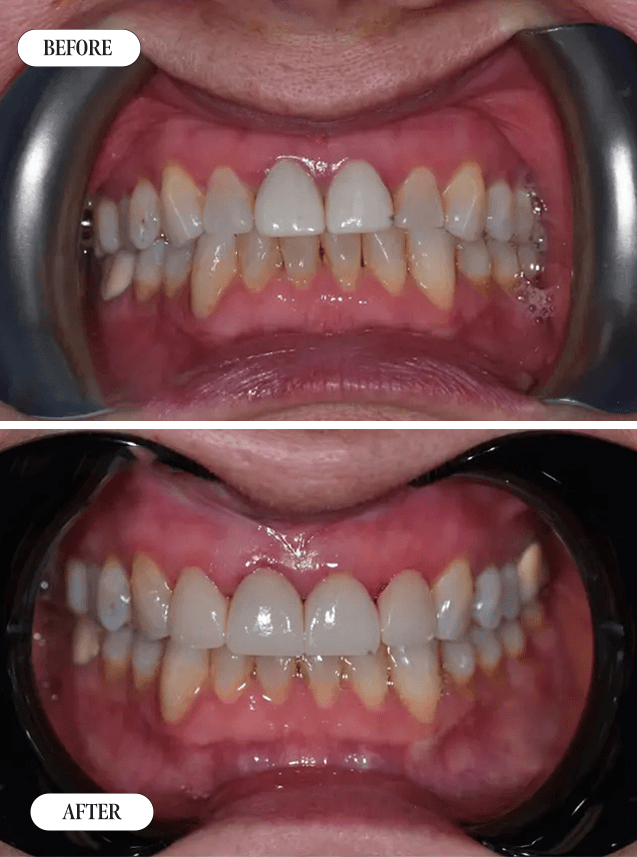 Smile Transformation 6 - Before and After