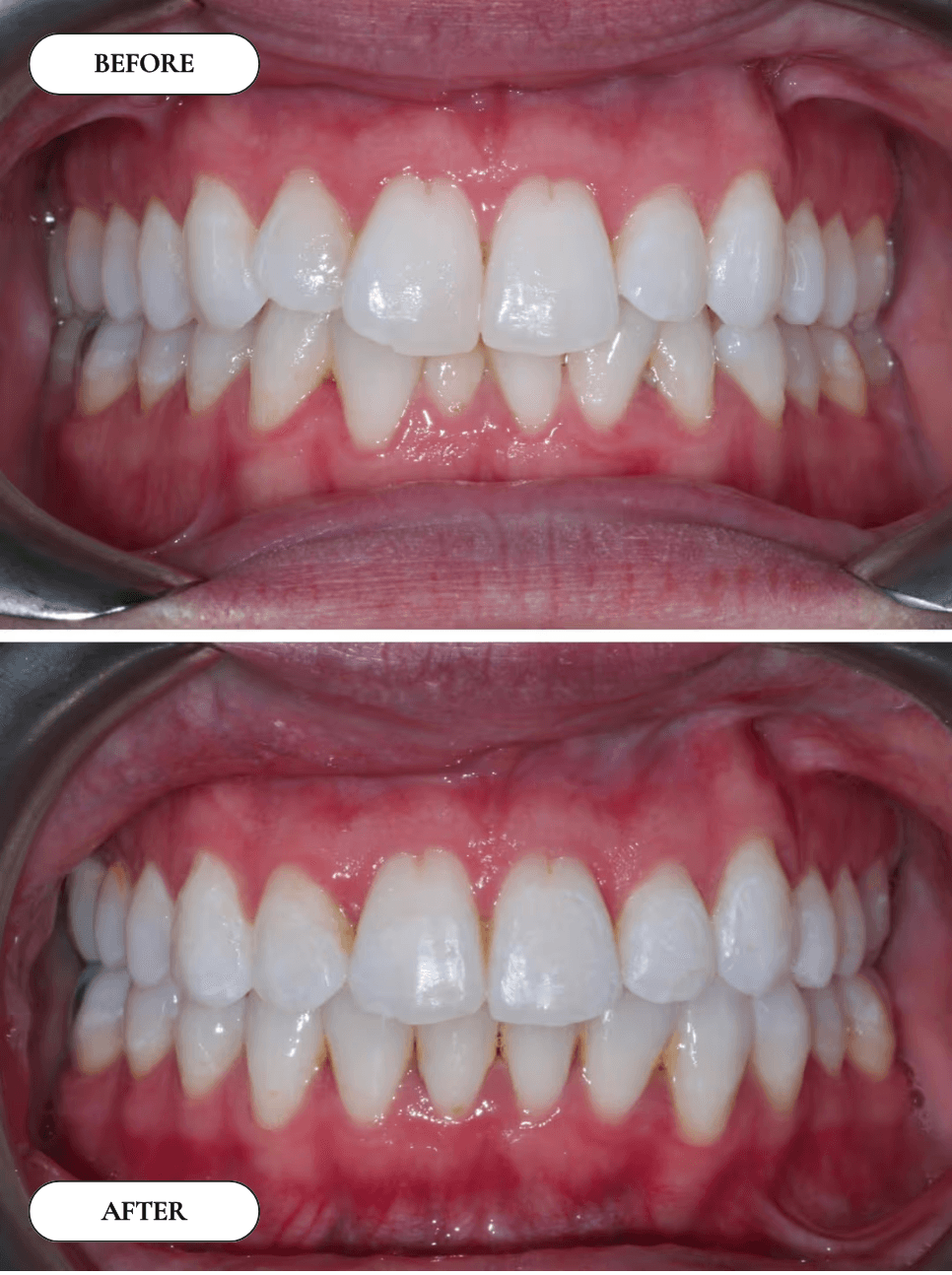 Smile Transformation 7 - Before and After