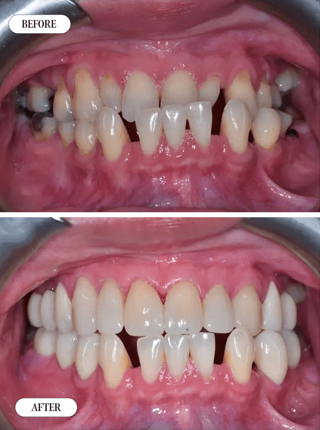 Smile Transformation 8 - Before and After