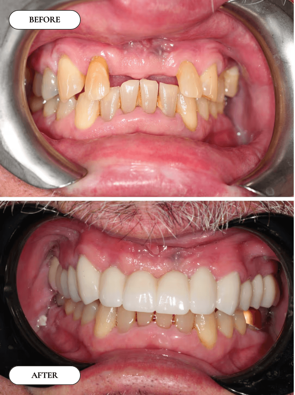 Smile Transformation 9 - Before and After