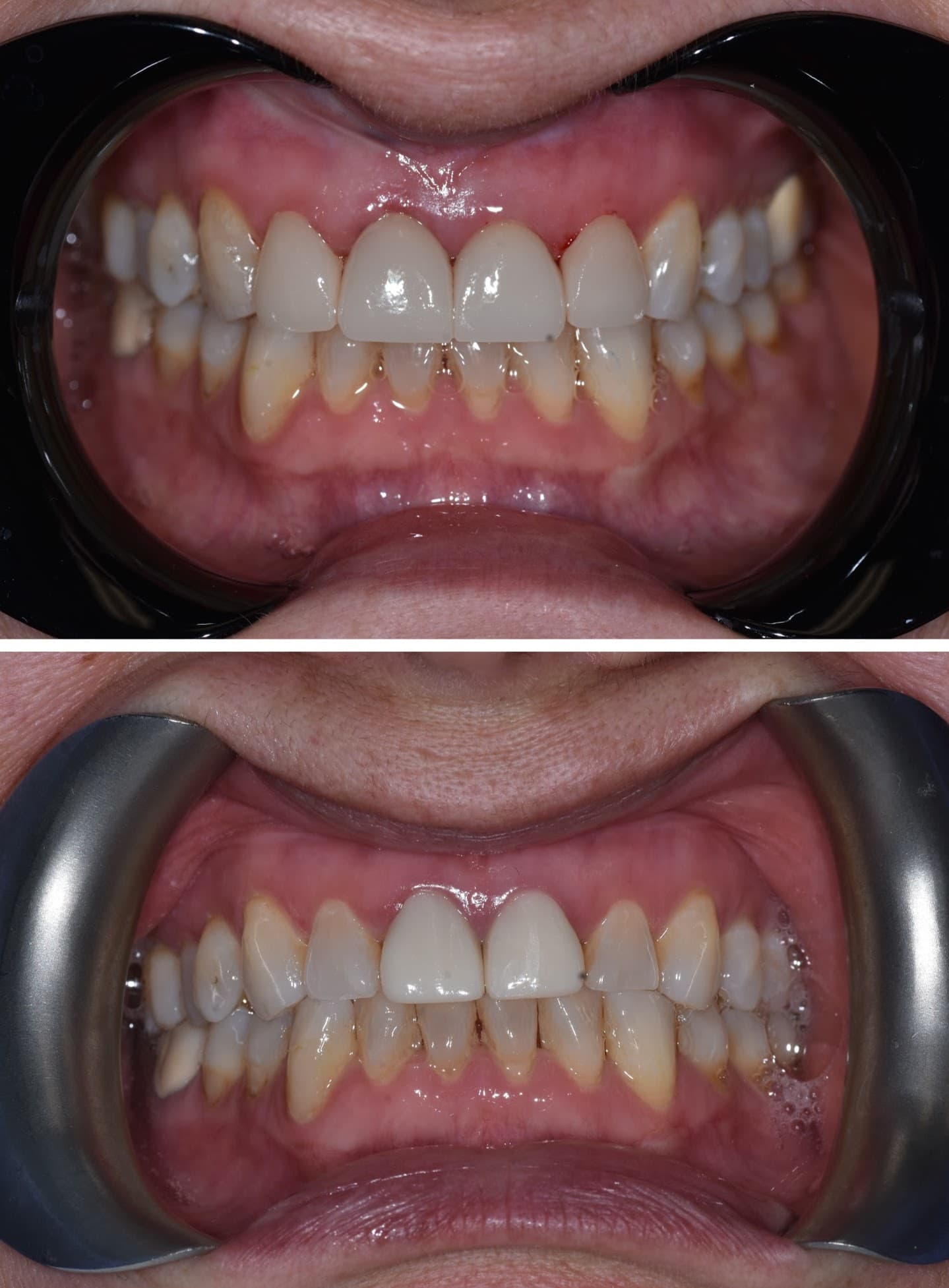Smile Transformation 7 - Before and After