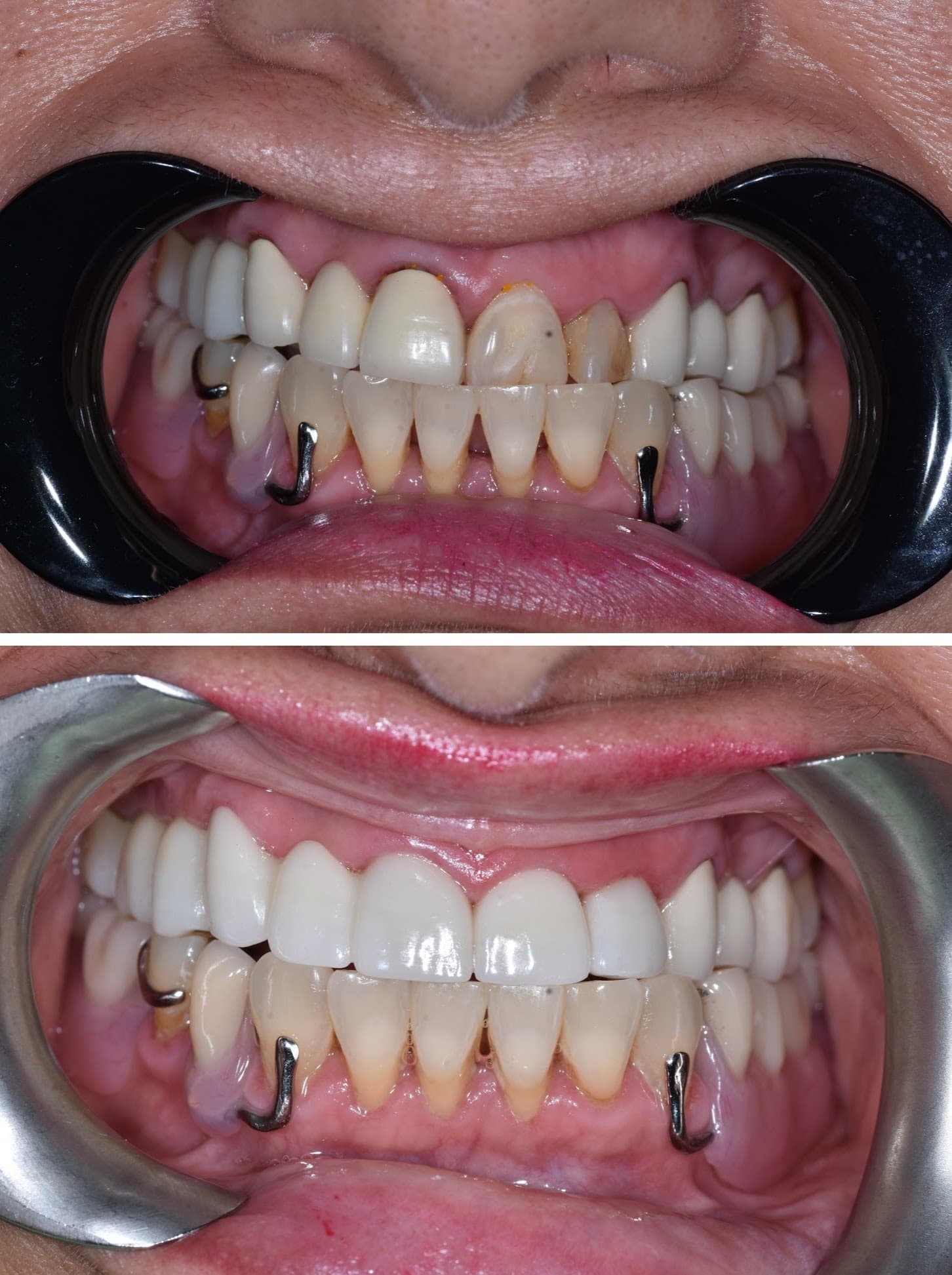 Smile Transformation 5 - Before and After