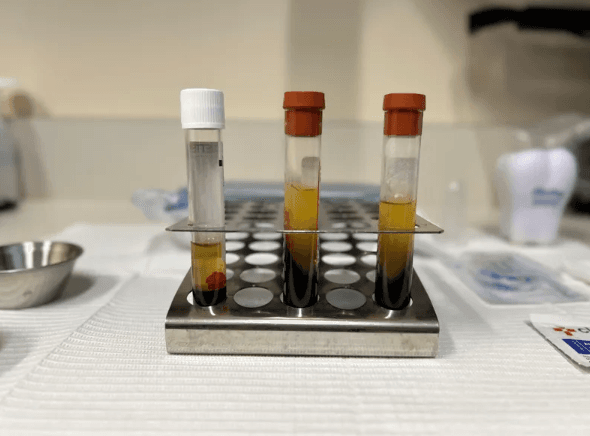 Platelet Rich Fibrin Therapy