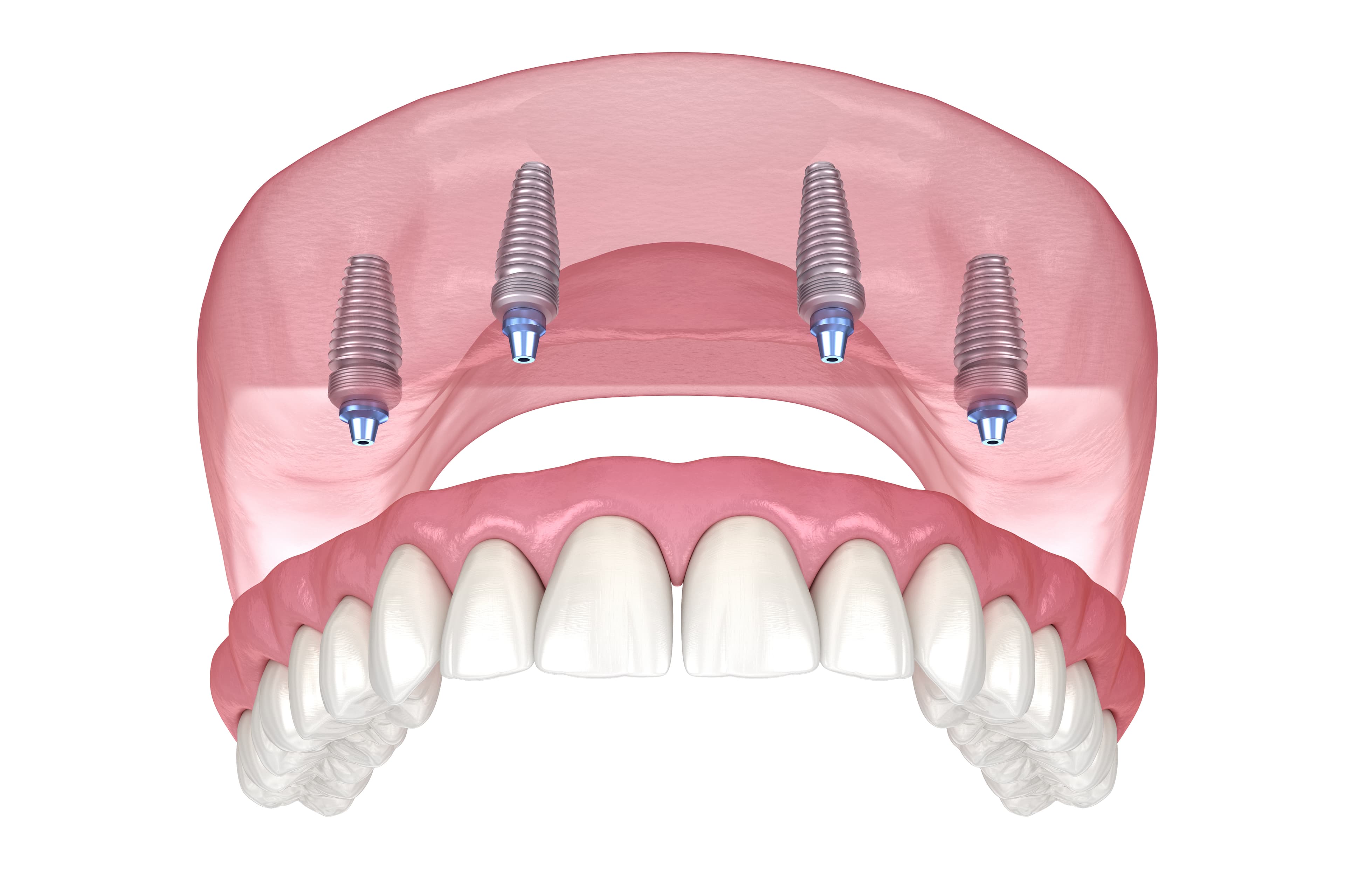 All-on-4Â® Implant Dentures - Stockton, CA