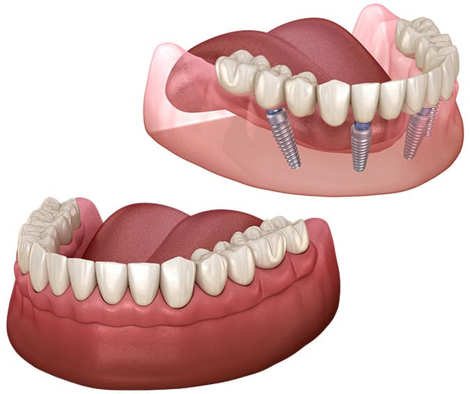 Permanent Teeth in a Day: Is It Possible with Full Mouth Implants?