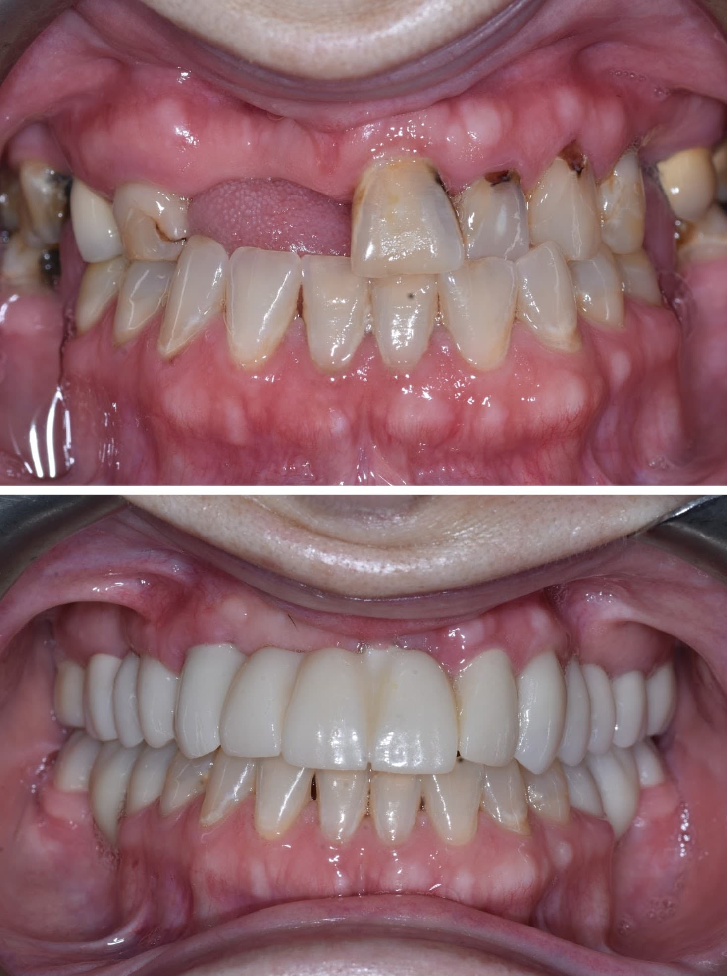 Smile Transformation 11 - Before and After