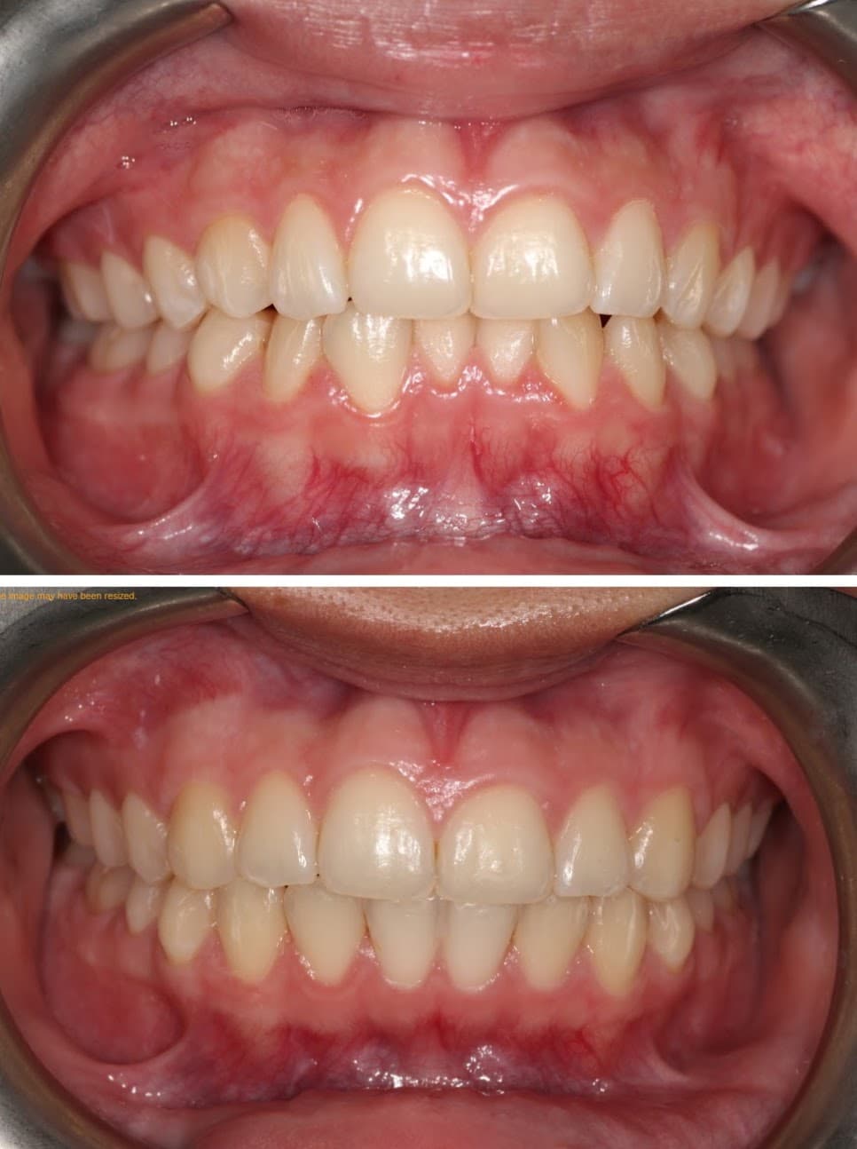 Smile Transformation 2 - Before and After