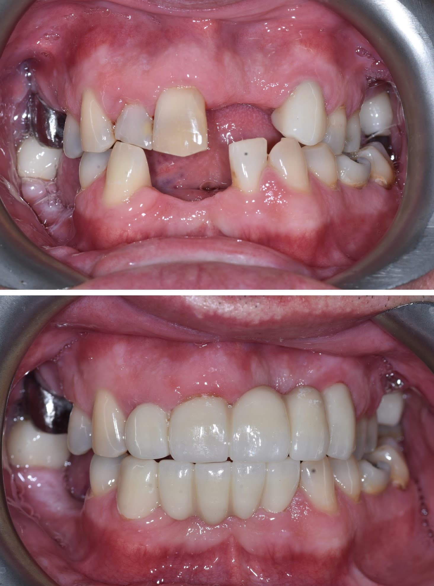 Smile Transformation 3 - Before and After