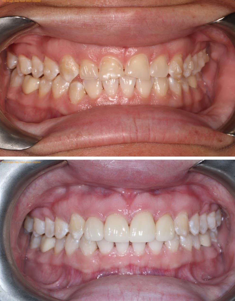 Smile Transformation 4 - Before and After