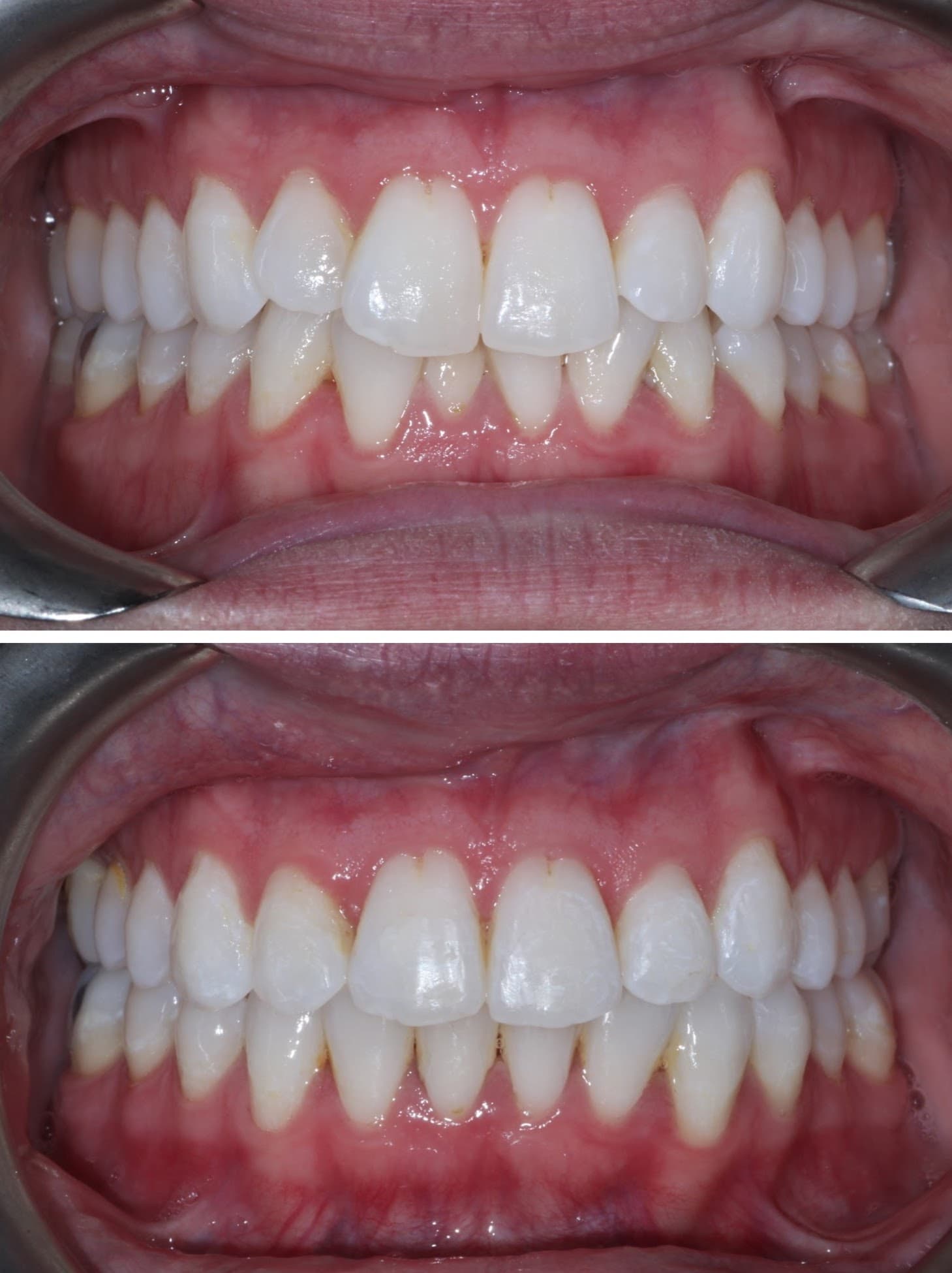 Smile Transformation 8 - Before and After
