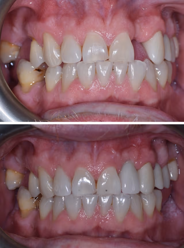 Cosmetic Dentistry - Before and After
