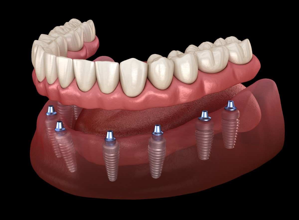 All-on-X dental implants in Stockton, CA