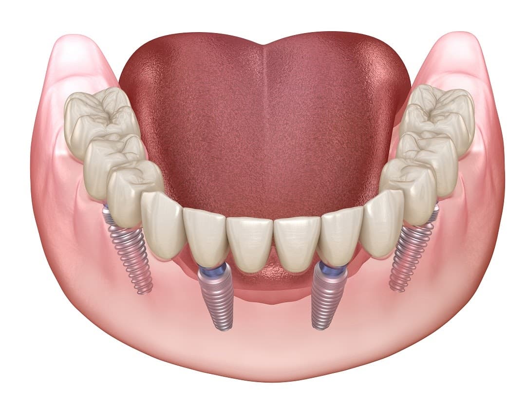 Dental Implants - Stockton, CA Dentist