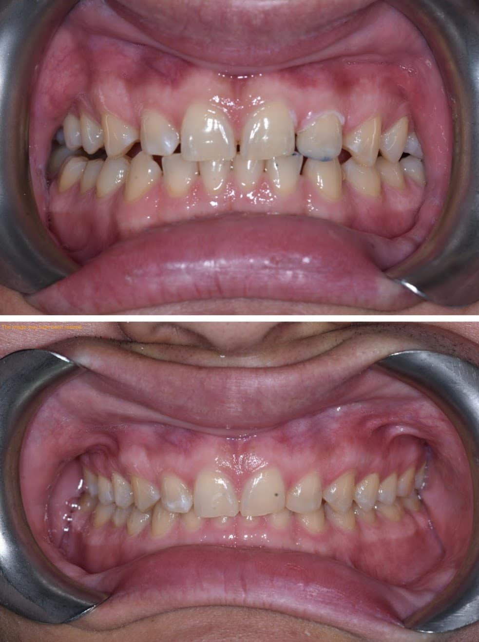 Smile Transformation 12 - Before and After