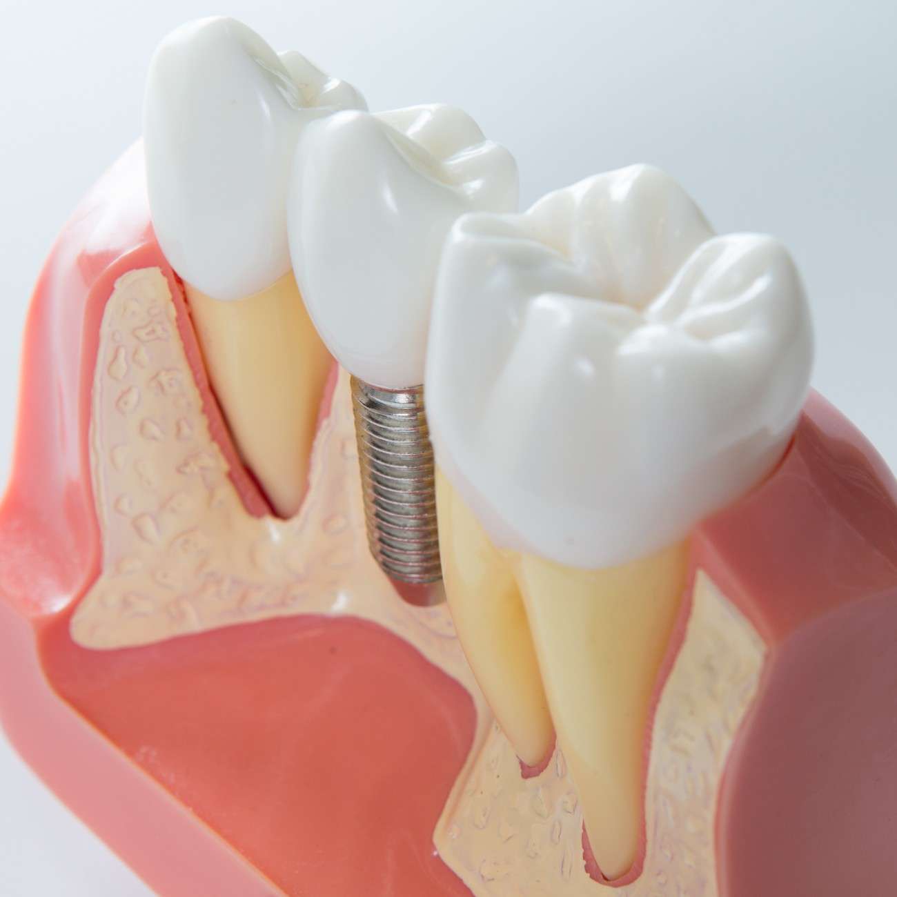Dental implant tooth replacement options in Stockton , California