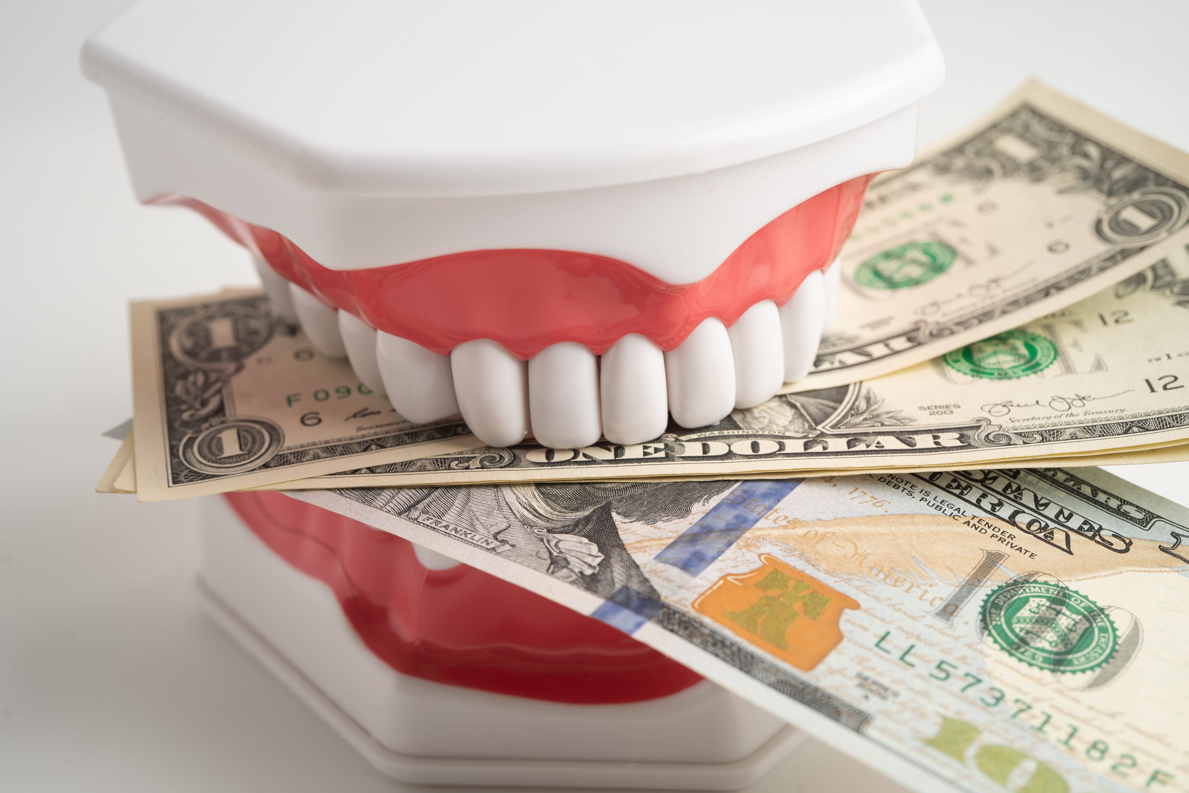 Dental Implant Insurance: What’s Covered & What’s Not?