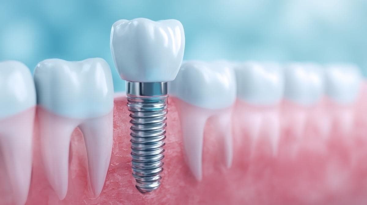Cost of dental implants in Lodi , California