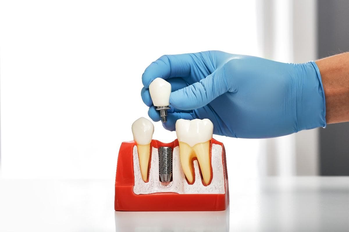 Cost of dental implants in Manteca, California