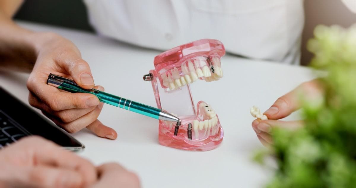 Cost of dental implants in Stockton , California