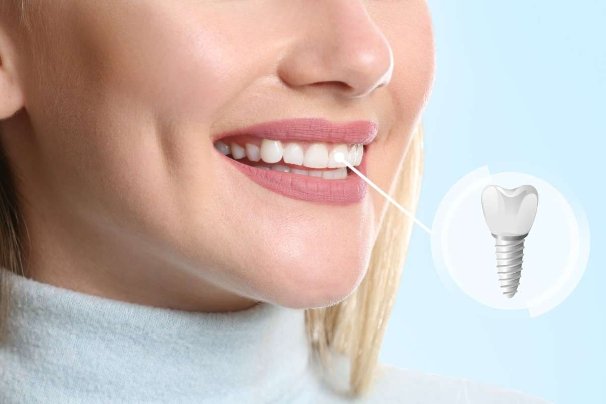 Cost of dental implants in Linden , California