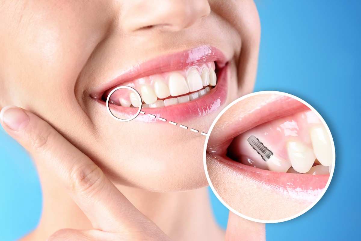 Cost of dental implants in San Joaquin, California