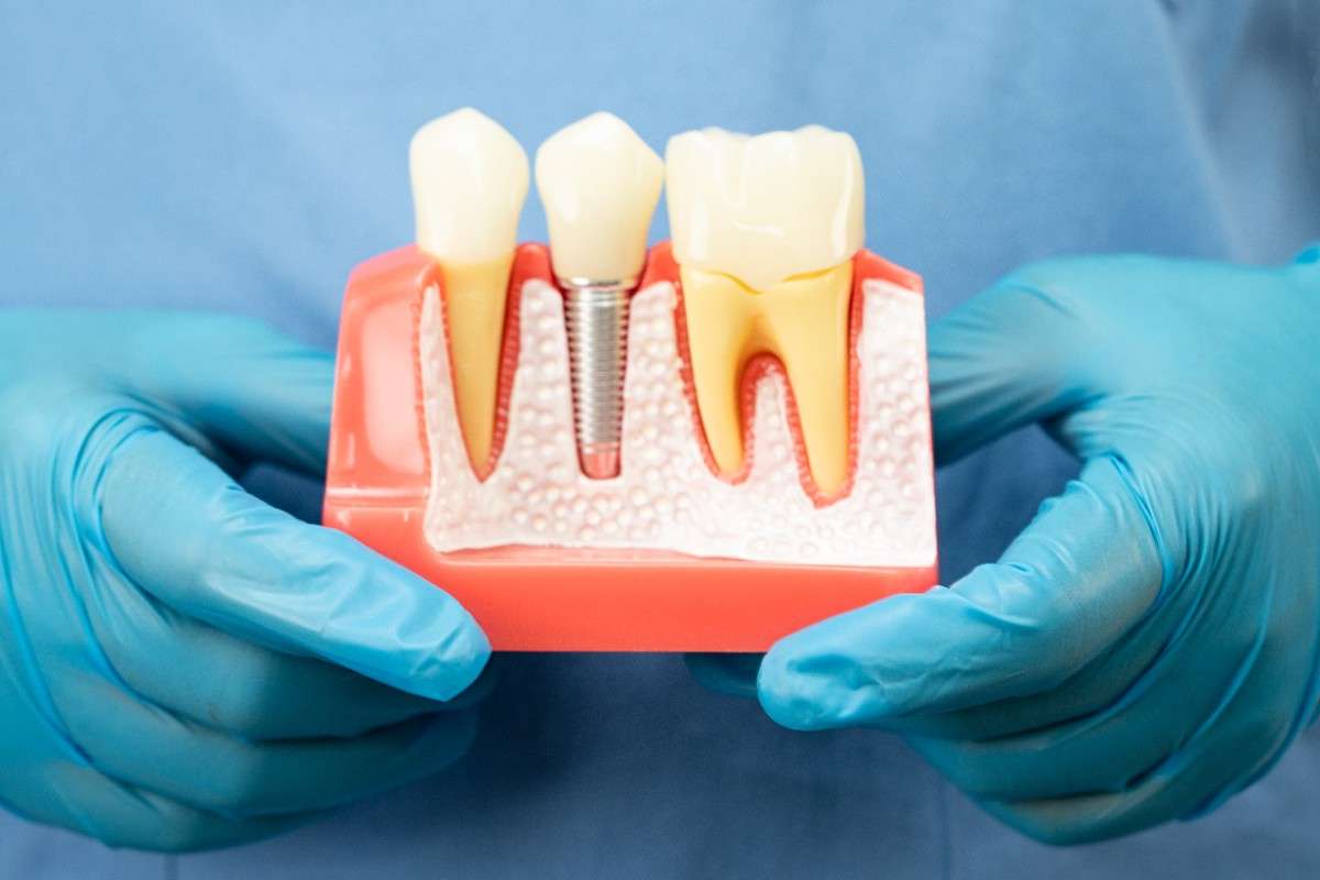 Cost of dental implants in Lincoln Village , California