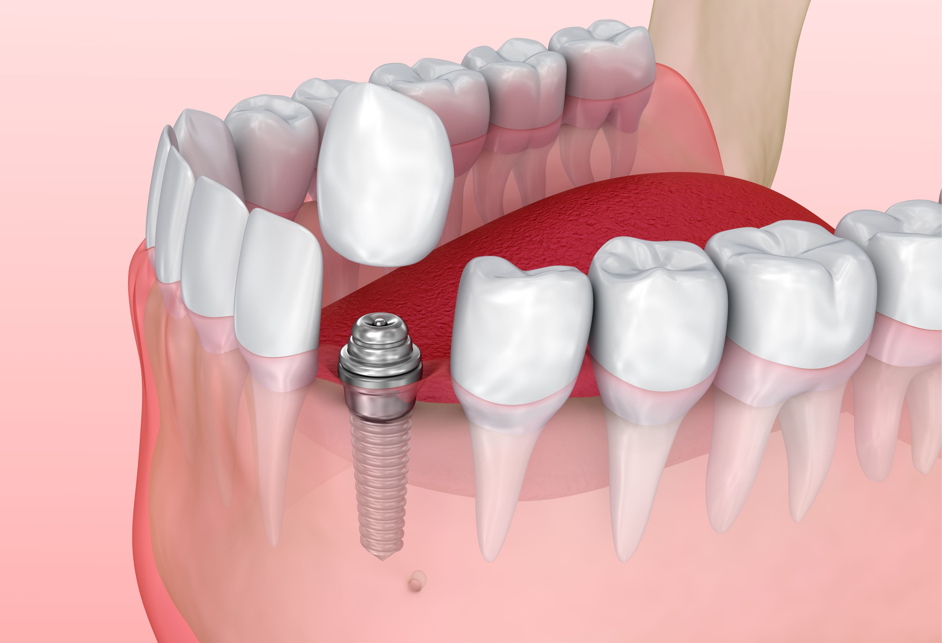 Can I Get Complete Dental Implants If I Have Bone Loss?