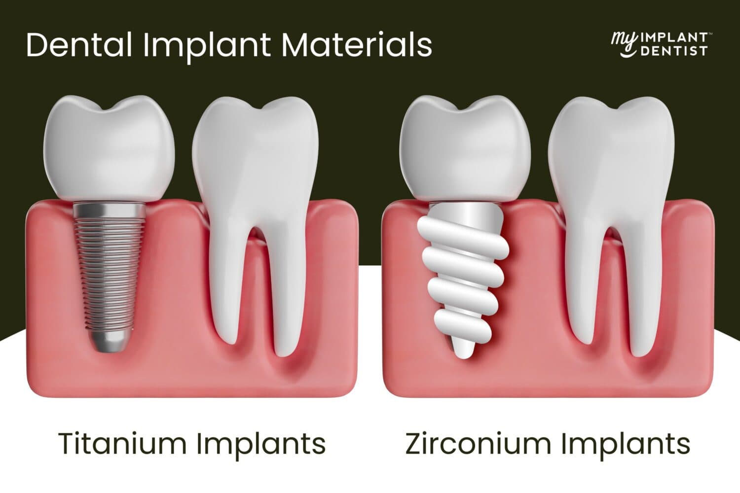 What Are the Different Materials Used for Dental Implants?